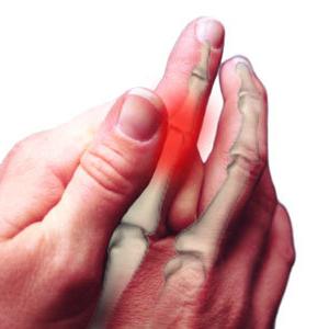 Artritis de los dedos: tratamiento, causas, síntomas